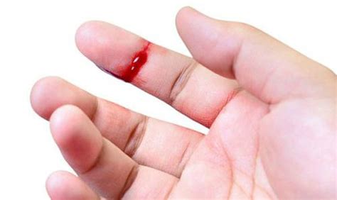 cách cầm máu khi bị đứt đầu ngón tay